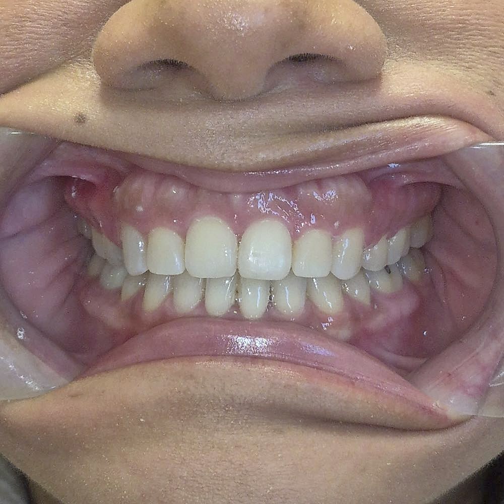 Juanita's straight, aligned teeth after orthodontic treatment at Harmony Orthodontics