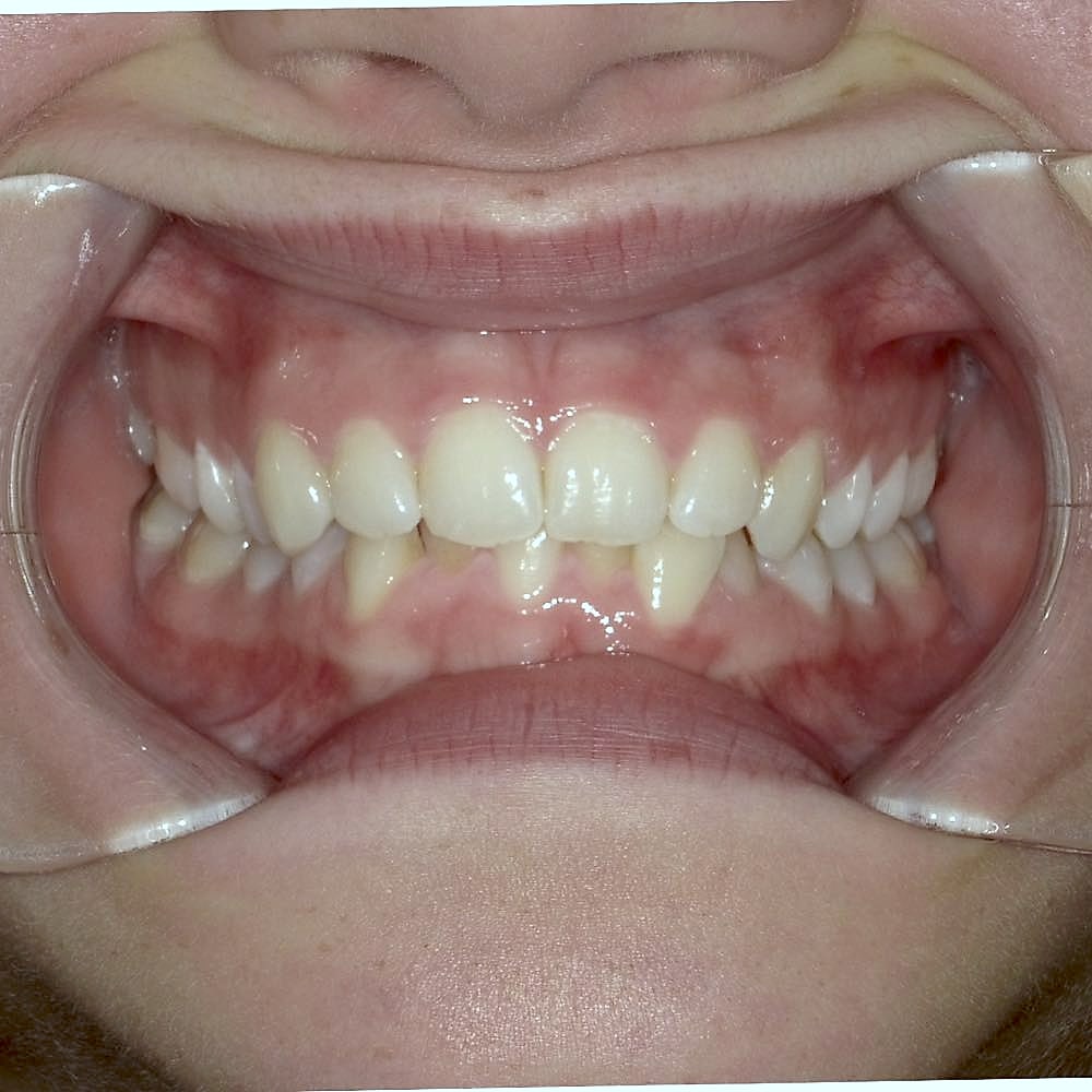 Kayden's teeth before orthodontic treatment at Harmony Orthodontics