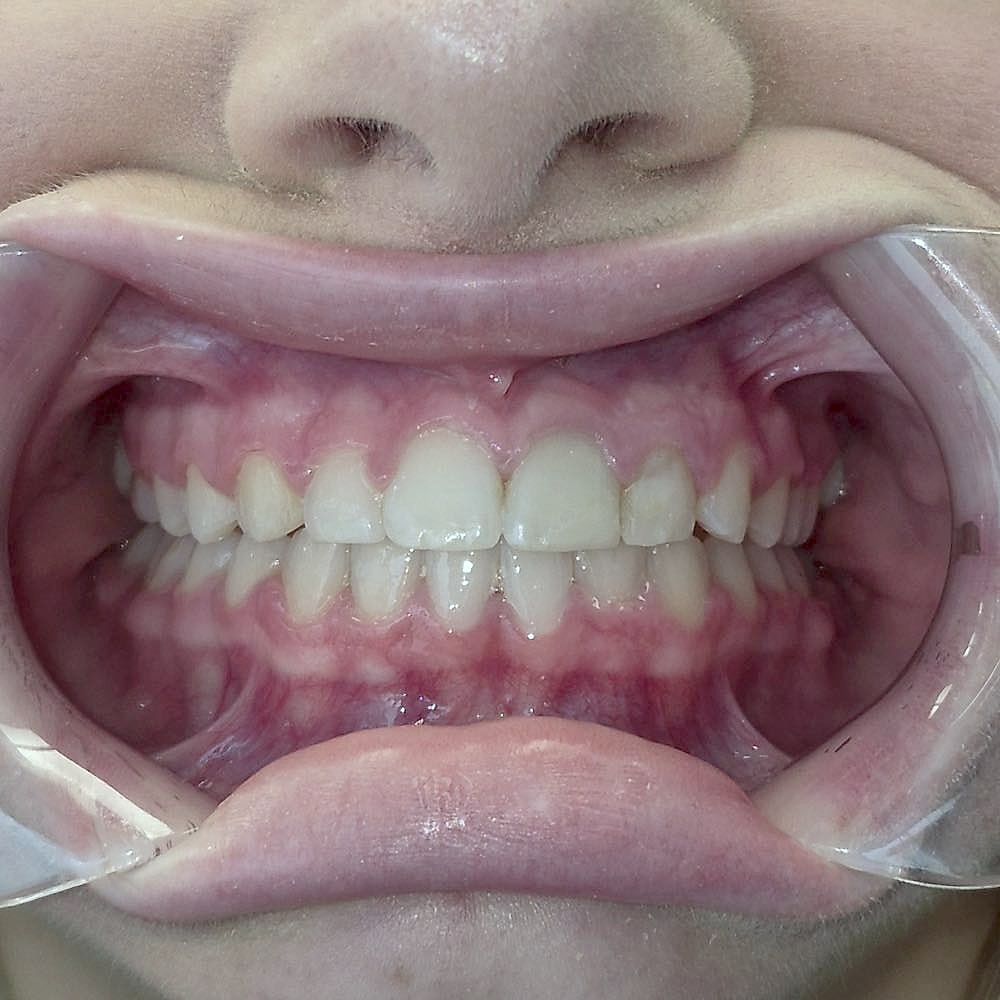 Kylie's straight, aligned teeth after orthodontic treatment at Harmony Orthodontics