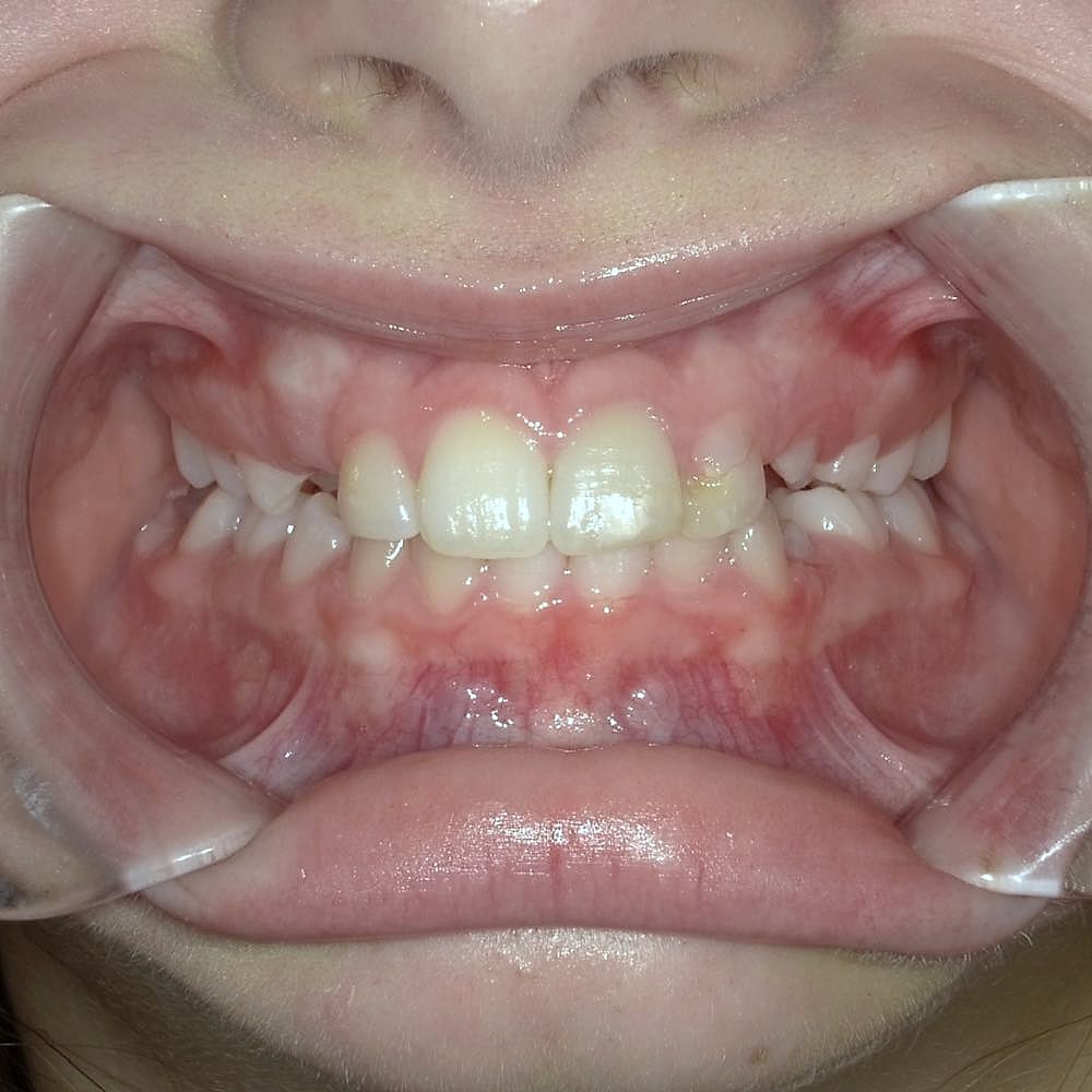 Kylie's teeth before orthodontic treatment at Harmony Orthodontics