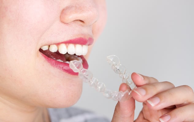 deep bite clear braces invisalign