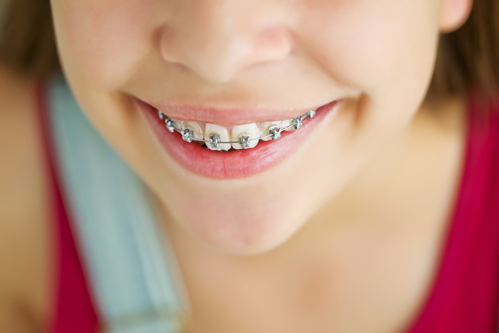 Early Orthodontics Treatment For Kids
