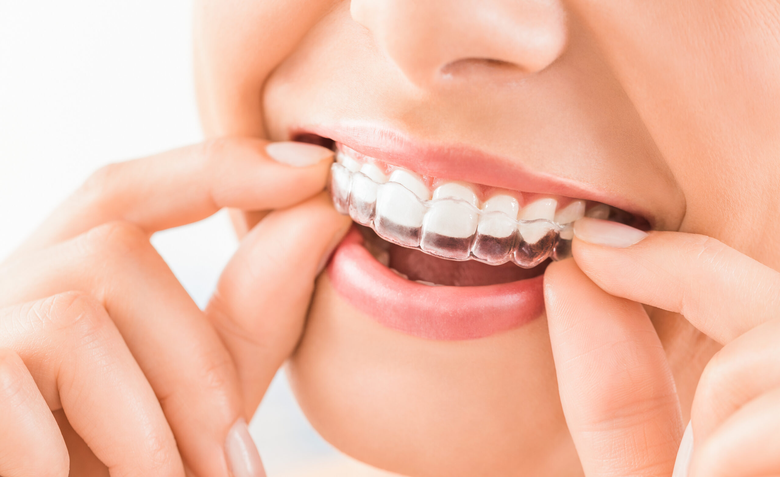 invisalign clear retainer