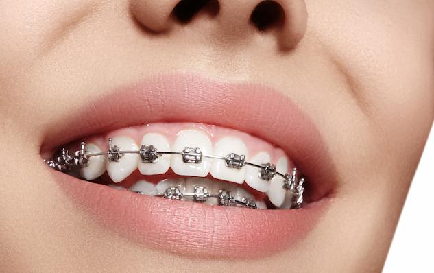 types of braces. metal braces.