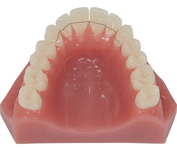Dental model with wire retainer on teeth