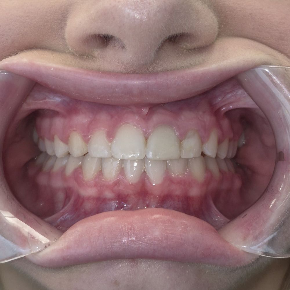 Close-up of healthy teeth in an open mouth