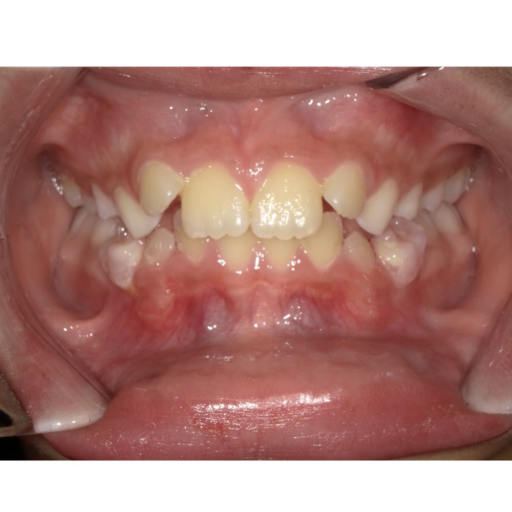 Close-up of child's teeth showing early dental development