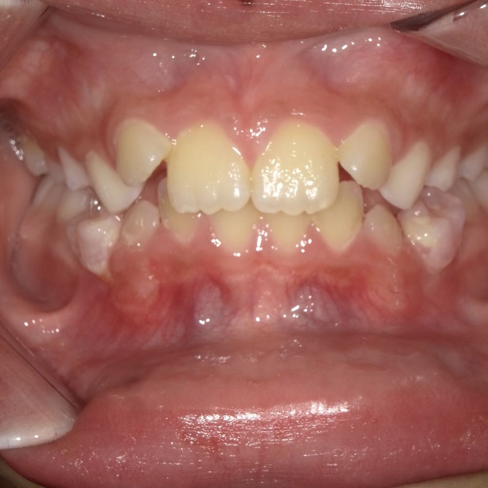 Close-up of child's open mouth showing teeth