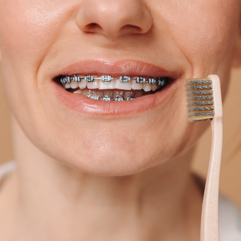 payment plans for braces